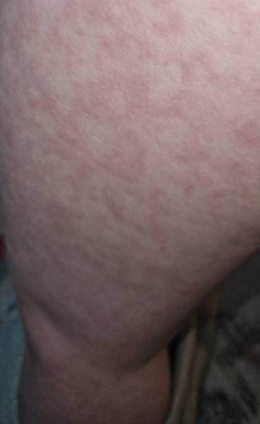 Bild zu Ausschlag, Antibiotikum? Masern? - Baby Forum - Allgemeine Themen