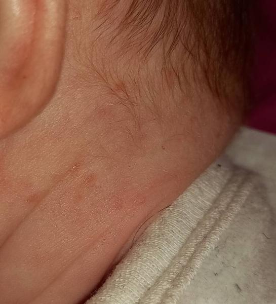 Bild zu Säugling Hautausschlag Hals - Baby Forum - Allgemeine Themen