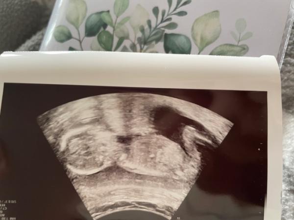 Bild zu Baby Geschlecht. Nub Theorie möglich? - Baby Forum - Allgemeine Themen