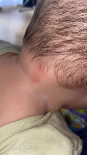 Bild zu Pickel oder Ausschlag??? - Baby Forum - Allgemeine Themen