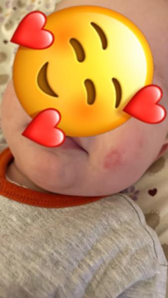Bild zu Kleine Wunde - Baby Forum - Allgemeine Themen