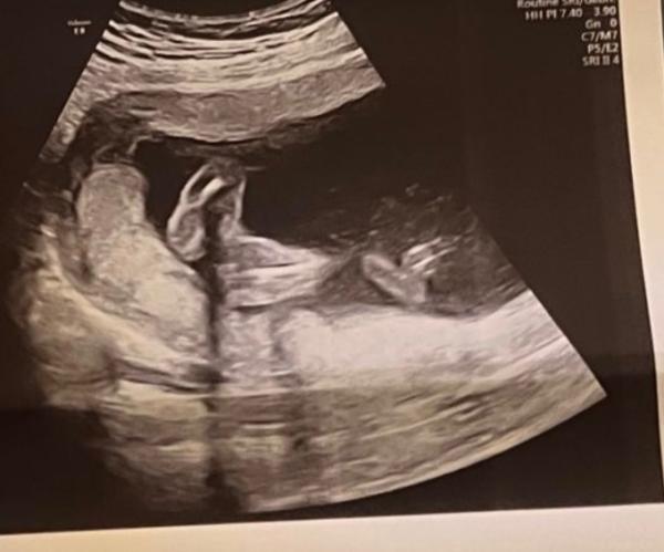Bild zu Geschlecht erkennen - Baby Forum - Allgemeine Themen