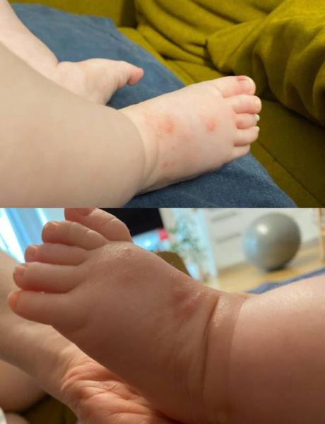 Bild zu Rote Flecken auf beiden Füßen (Säugling) - Baby Forum - Allgemeine Themen