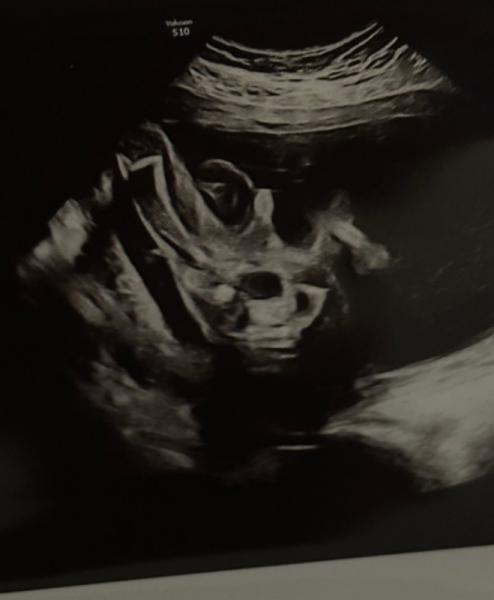 Bild zu SSW 22+3 - welches Geschlecht seht ihr? - Baby Forum - Allgemeine Themen