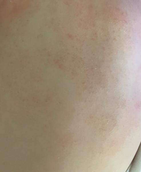 Bild zu Babyhaut wird nicht besser :( - Baby Forum - Allgemeine Themen