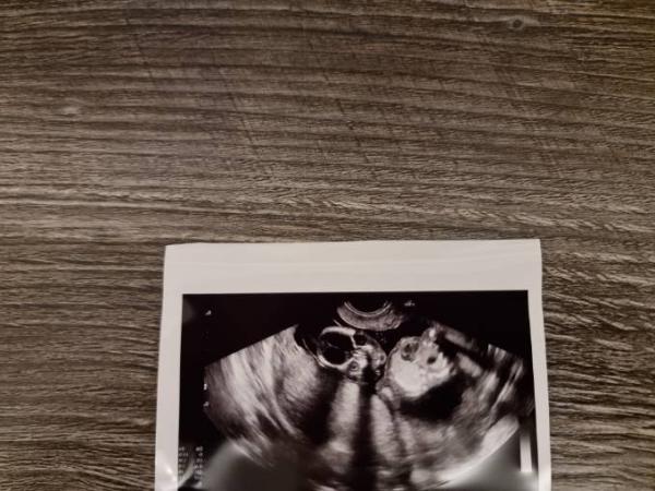Bild zu 15 ssw geschlecht erkennbar? - Baby Forum - Allgemeine Themen