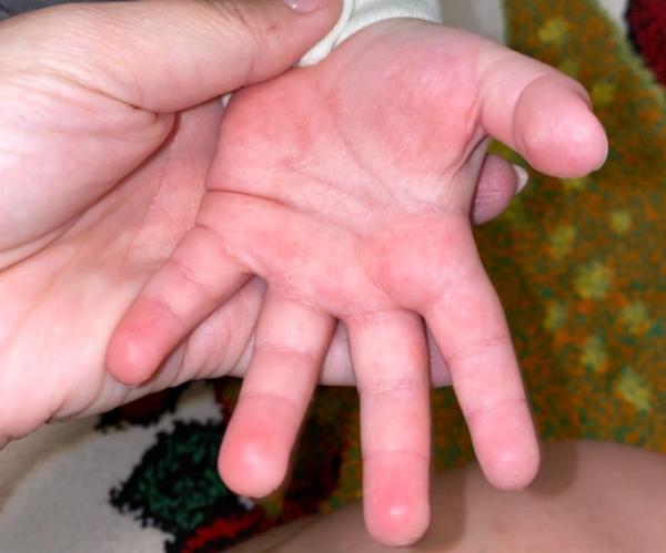 Bild zu Nur noch fleckige Handflächen - Baby Forum - Allgemeine Themen
