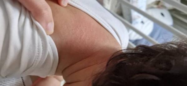 Bild zu Allergie oder Neurodermitis - Baby Forum - Allgemeine Themen