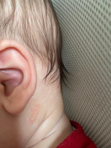 Bild zu Roter trockener fleck - Baby Forum - Allgemeine Themen