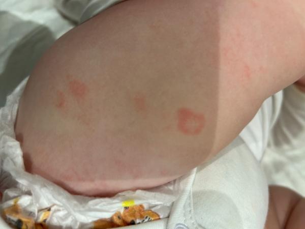 Bild zu Ausschlag rote Ringförmige Flecken - Baby Forum - Allgemeine Themen