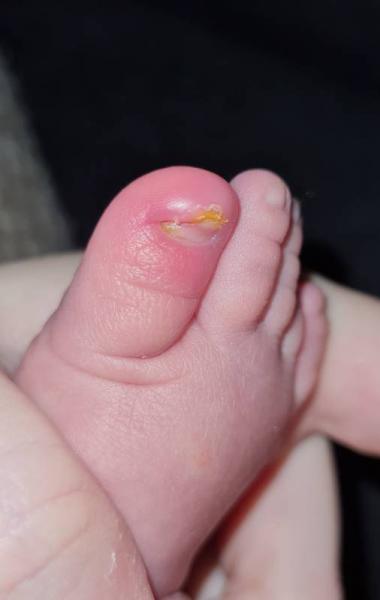 Bild zu Große Zehen entzündet - Baby Forum - Allgemeine Themen