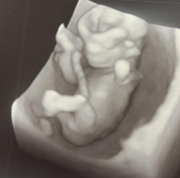 Bild zu Geschlecht w/m ? 12+3 ssw - Baby Forum - Allgemeine Themen