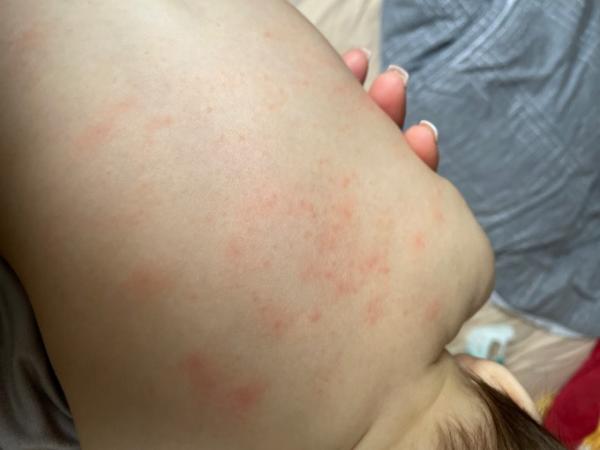 Bild zu Ausschlag Baby - Baby Forum - Allgemeine Themen