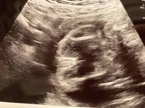 Bild zu Erkennt ihr das Geschlecht SSW 25? - Baby Forum - Allgemeine Themen