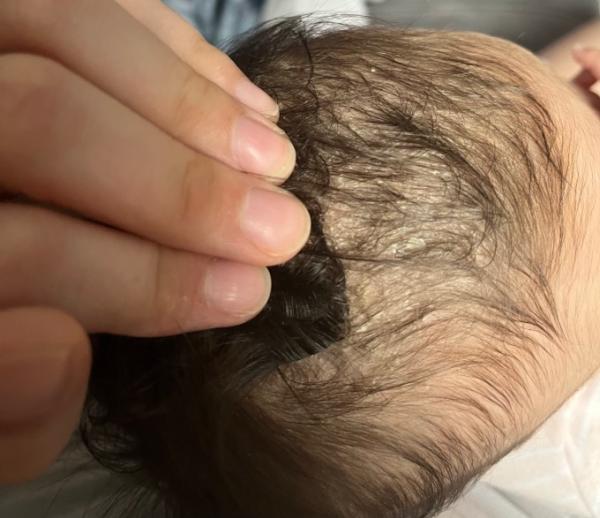 Bild zu Was ist das ? Kopfgneis? - Baby Forum - Allgemeine Themen