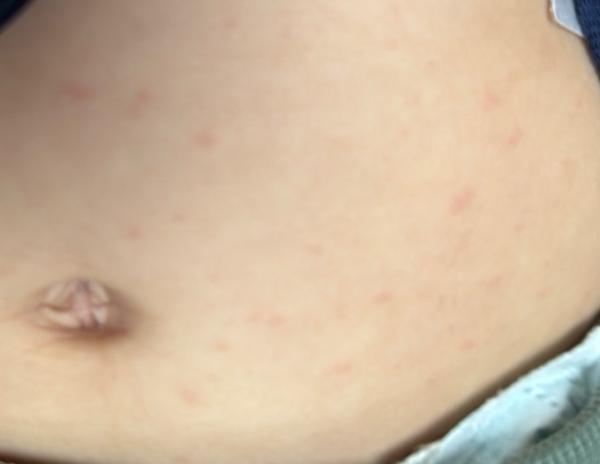 Bild zu Nach Magendarm ausschlag - Baby Forum - Allgemeine Themen