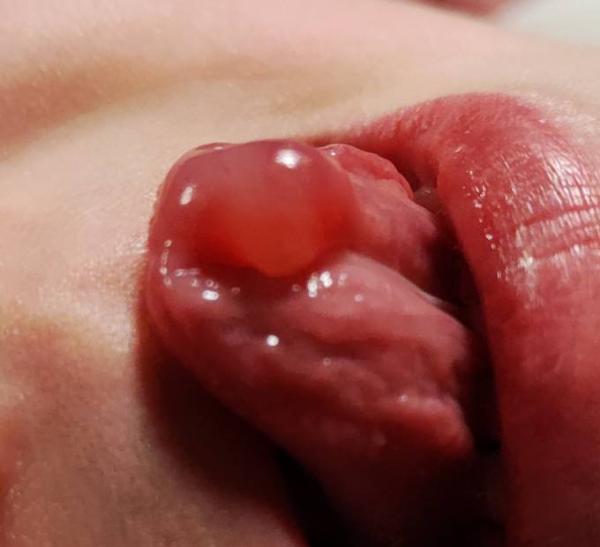 Bild zu Geschwulst unter der Zunge - Baby Forum - Allgemeine Themen
