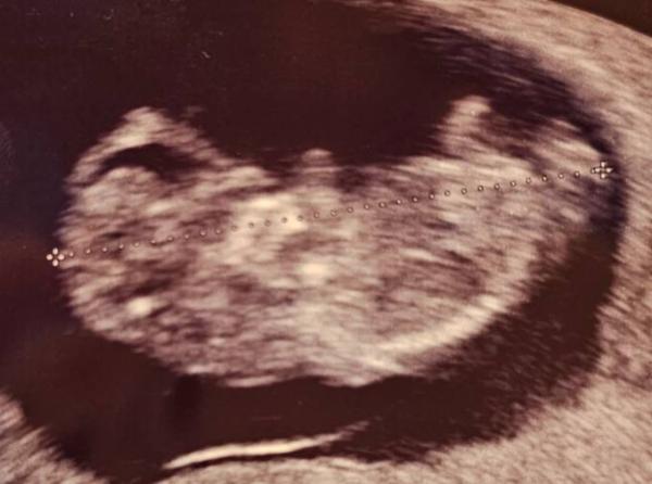 Bild zu MĂ€dchen oder Junge? SSW13đ„°â€ïž - Baby Forum - Allgemeine Themen