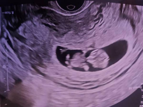 Bild zu Geschlecht erkennen - Baby Forum - Allgemeine Themen