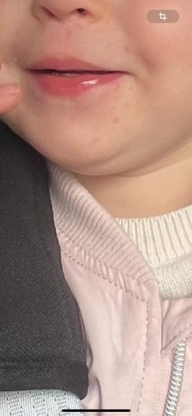 Bild zu Beginn von Hand Mund Fuß ? - Baby Forum - Allgemeine Themen