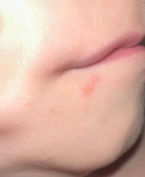 Bild zu Herpes? - Baby Forum - Allgemeine Themen