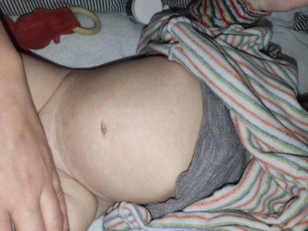 Bild zu Ausschlag an Bauch und Brust - Baby Forum - Allgemeine Themen