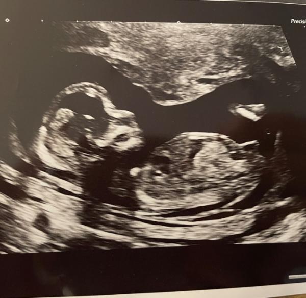 Bild zu Kennt sich jemand mit der Nub Theorie aus? - Baby Forum - Allgemeine Themen