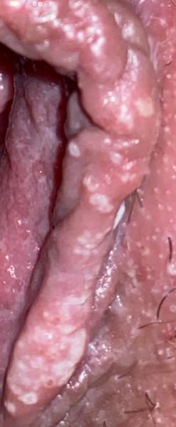 Bild zu SSW 33+4 / Genitalherpes??? - Baby Forum - Allgemeine Themen