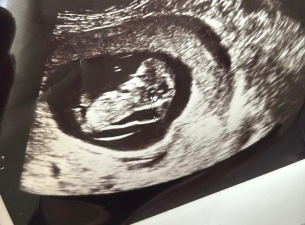 Bild zu Nackenfalte - Baby Forum - Allgemeine Themen