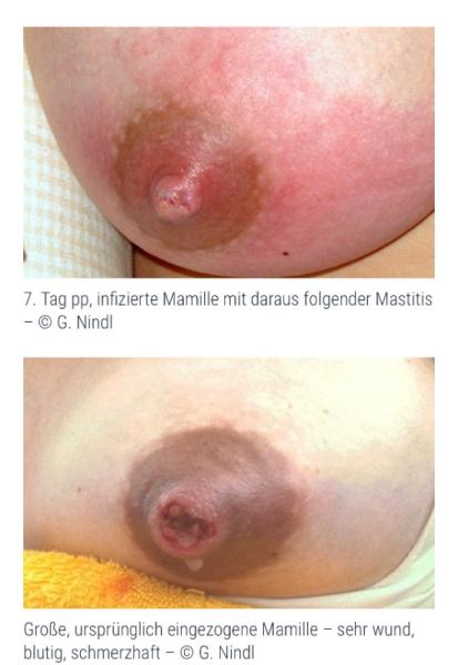 Bild zu Stillen - wunde, offene Mamille heilt nicht ab :( - Baby Forum - Allgemeine Themen