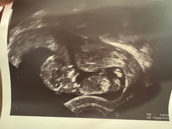 Bild zu Geschlechtserkennung - Baby Forum - Allgemeine Themen