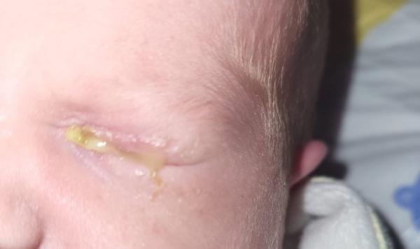 Bild zu Verklebtes Auge - Baby Forum - Allgemeine Themen