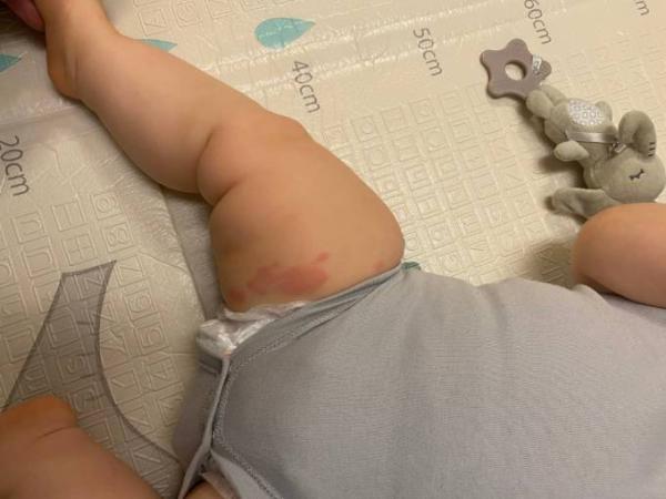 Bild zu Plötzlicher Ausschlag (8 Monate) - Baby Forum - Allgemeine Themen