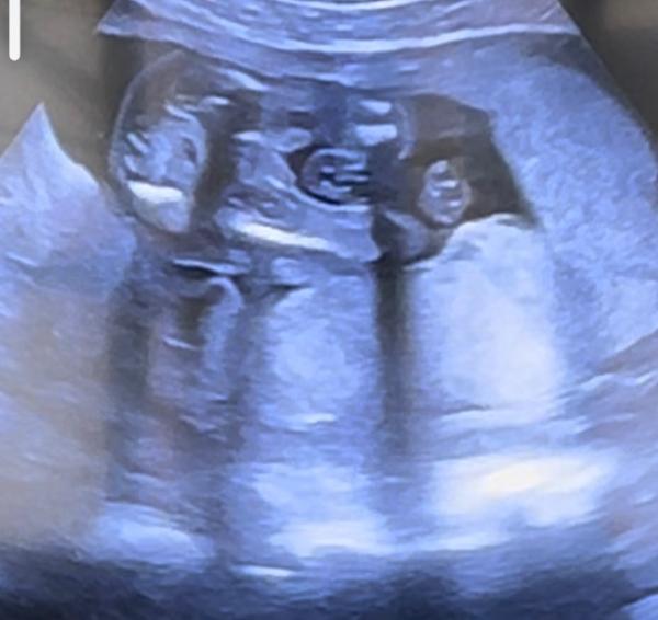 Bild zu Geschlecht erraten - Baby Forum - Allgemeine Themen