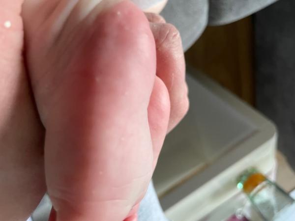 Bild zu Weiße Stellen am fuß - Baby Forum - Allgemeine Themen