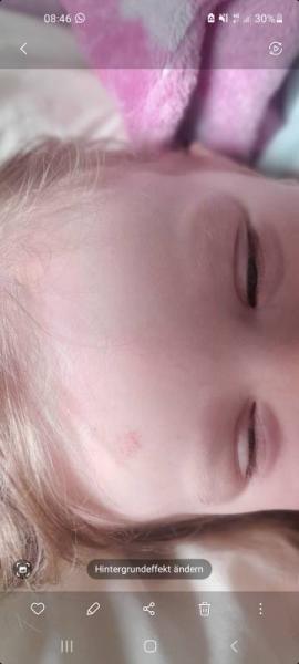 Bild zu Hauteinblutungen ohne Grund - Baby Forum - Allgemeine Themen
