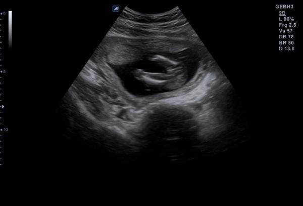 Bild zu Geschlecht erkennen? - Baby Forum - Allgemeine Themen