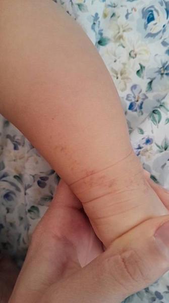 Bild zu Pigmentflecken Baby - Baby Forum - Allgemeine Themen