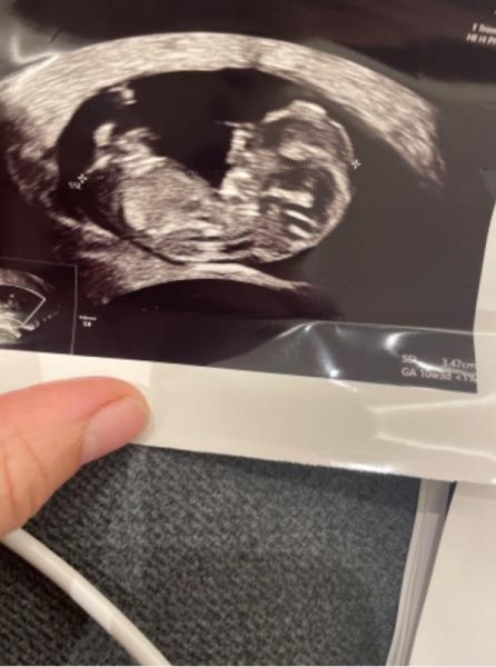 Bild zu NUB Theorie, kennt sich wer aus? - Baby Forum - Allgemeine Themen