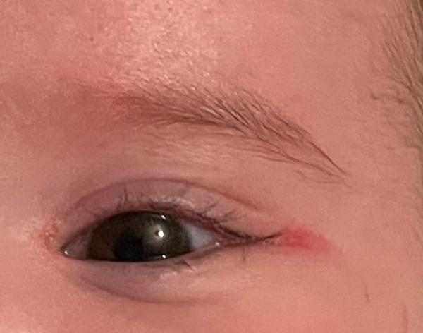 Bild zu Augen wunde - Baby Forum - Allgemeine Themen