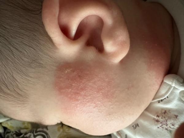Bild zu Hautausschlag breitet sich aus - Baby Forum - Allgemeine Themen