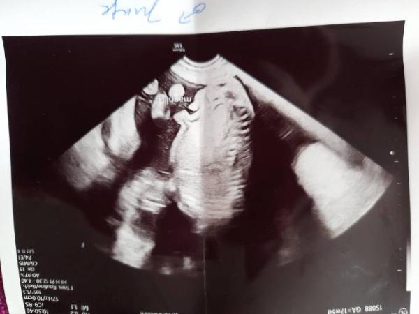 Bild zu Baby Geschlecht - Baby Forum - Allgemeine Themen