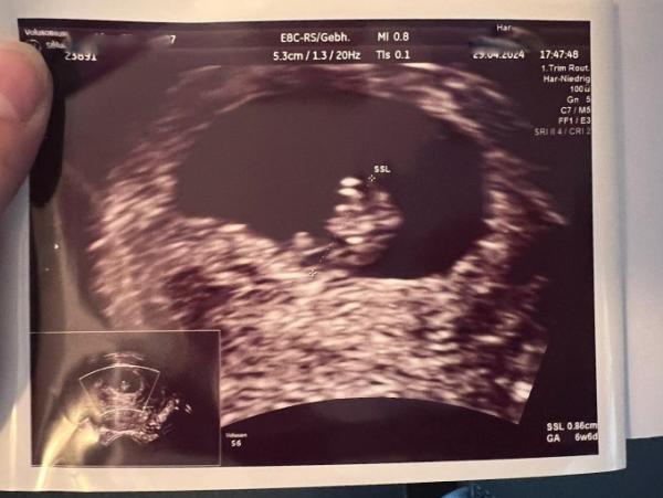 Bild zu Ramzi-Methode Geschlecht bestimmen - Baby Forum - Allgemeine Themen