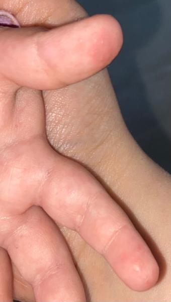 Bild zu Kleine Pickel/Hubbel an zwei Finger - Baby Forum - Allgemeine Themen