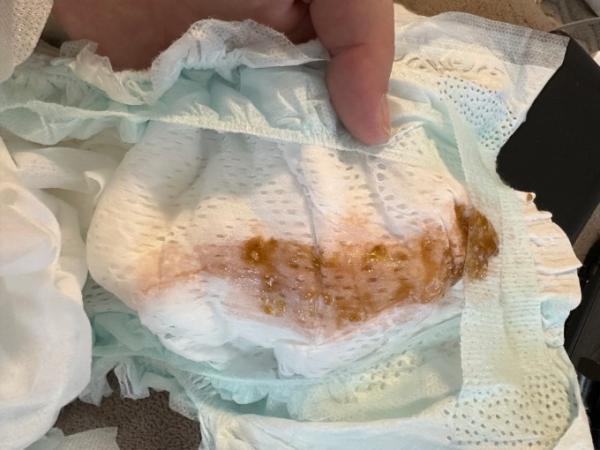 Bild zu Blut(?) im Stuhl - ACHTUNG Foto! - Baby Forum - Allgemeine Themen