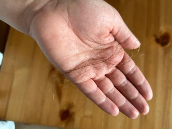 Bild zu Starker Haarausfall- oder doch normal? - Baby Forum - Allgemeine Themen
