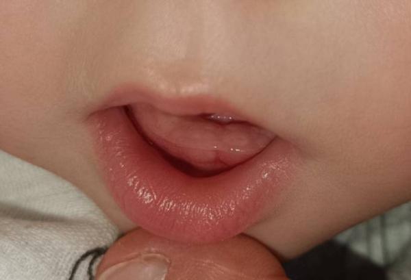 Bild zu Bekommt er seinen Zahn ? - Baby Forum - Allgemeine Themen