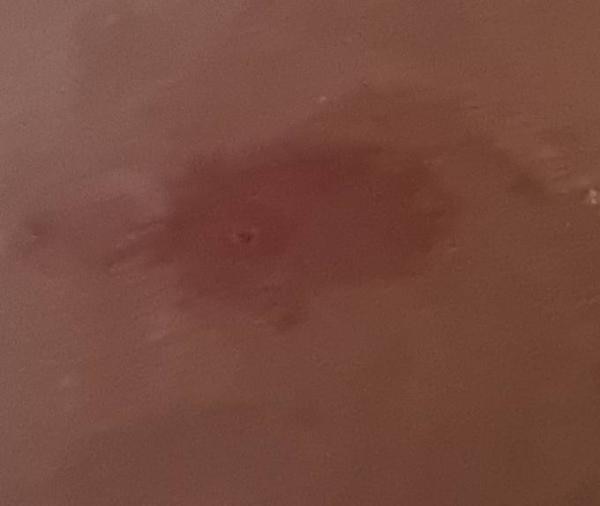Bild zu Borreliose - Baby Forum - Allgemeine Themen