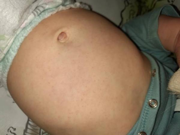Bild zu Ausschlag Bauch - Baby Forum - Allgemeine Themen