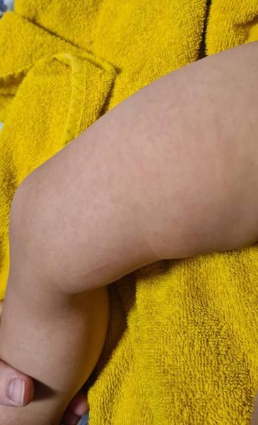 Bild zu Ausschlag ohne weitere Symptome - Baby Forum - Allgemeine Themen